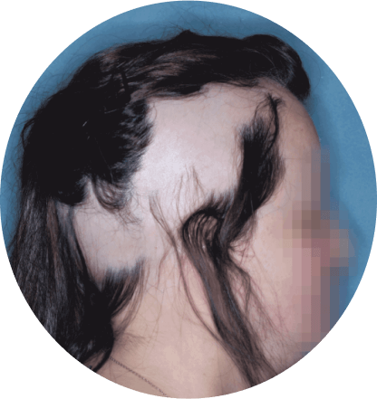 right profile of adult showing scalp hair coverage taken before treatment with olumiant 2mg once daily