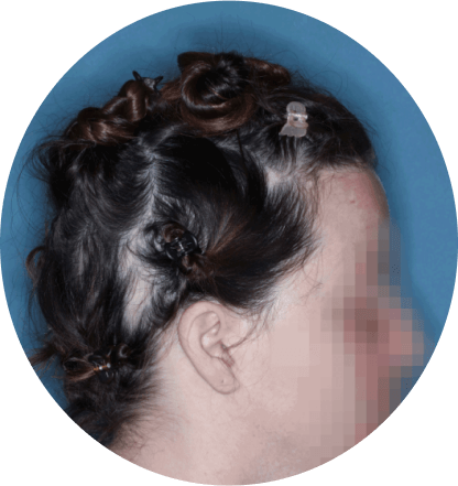 right profile of patient showing scalp hair coverage taken at 36 weeks with olumiant 2mg once daily