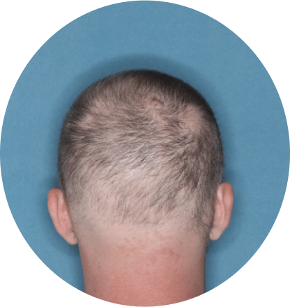 back of head of patient showing scalp hair coverage taken at 12 weeks with Olumiant 4 mg once daily